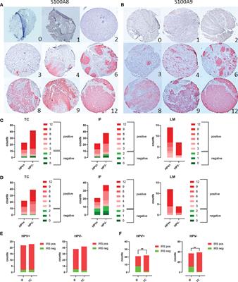 The prominent role of the S100A8/S100A9-CD147 axis in the progression of penile cancer